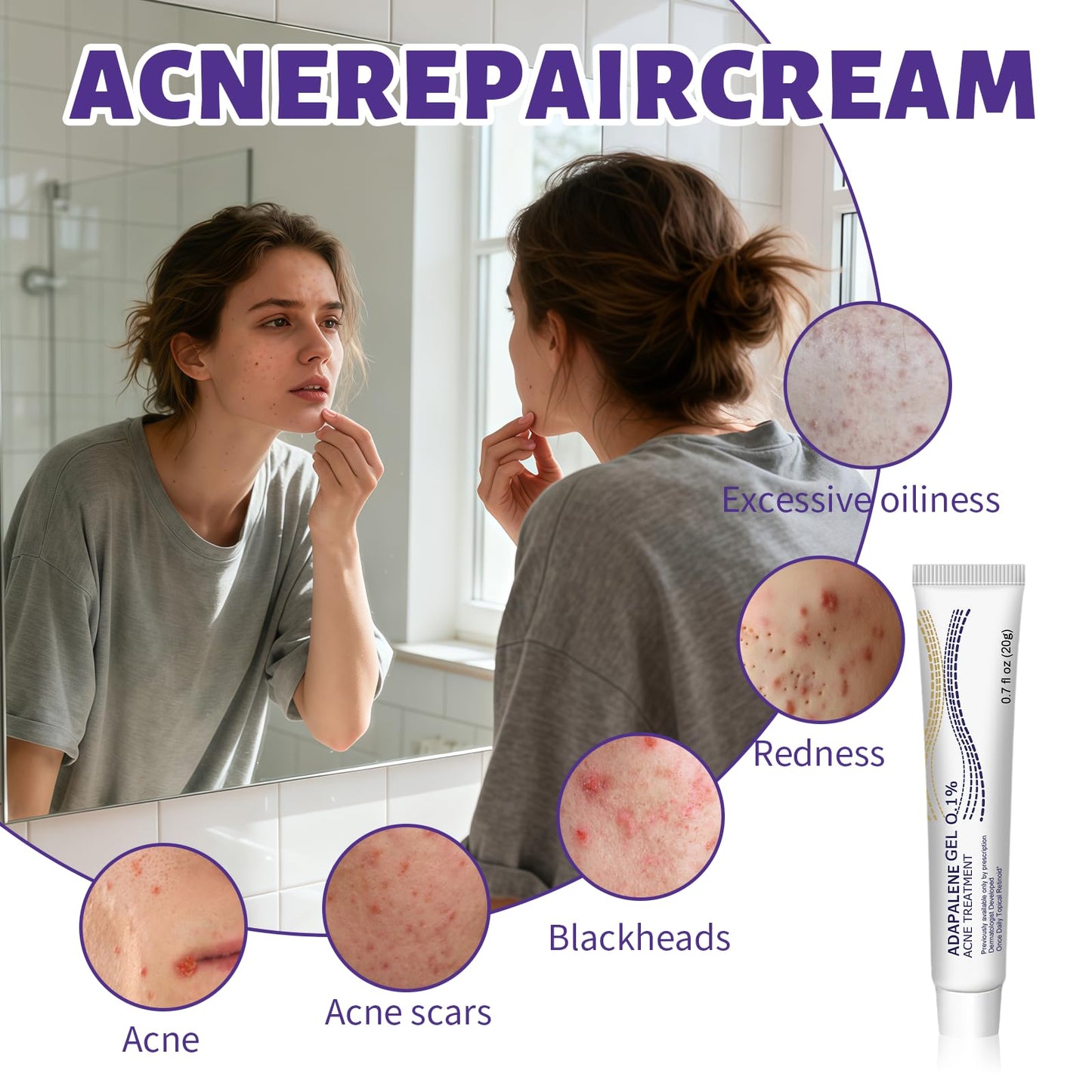 Acne Cream 20g, Spot cream, Reduces Pimples, Blemishes & Blackheads , Oil Control& Redness Relief, Providing soothing, Gentle Care for skin