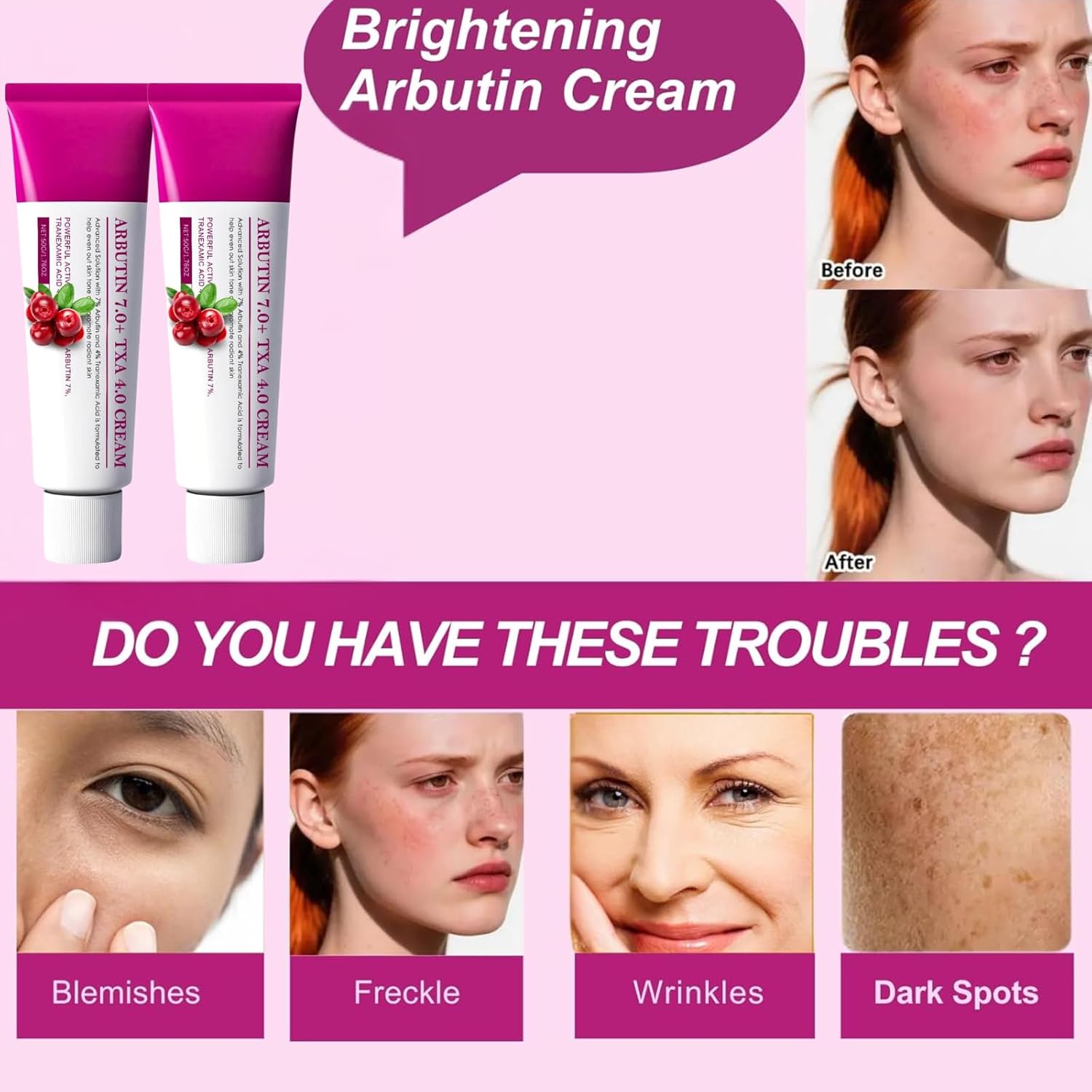 2PCS Arbutin 7% + Tranexamic Acid 4% Cream, Dark Spot Remover for Face Hyperpigmentation, Reduces Freckles & Blemishes,Even Skin Tone, Brightening Moisturiser with Glutathione & Niacinamide