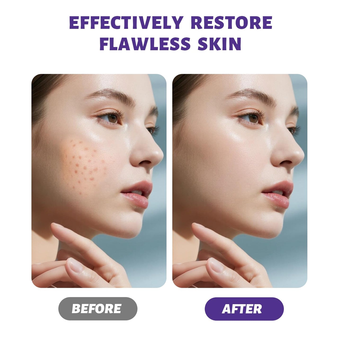 Acne Cream 20g, Spot cream, Reduces Pimples, Blemishes & Blackheads , Oil Control& Redness Relief, Providing soothing, Gentle Care for skin