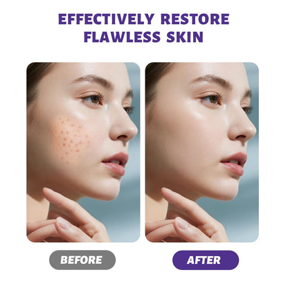 Acne Cream 20g, Spot cream, Reduces Pimples, Blemishes & Blackheads , Oil Control& Redness Relief, Providing soothing, Gentle Care for skin