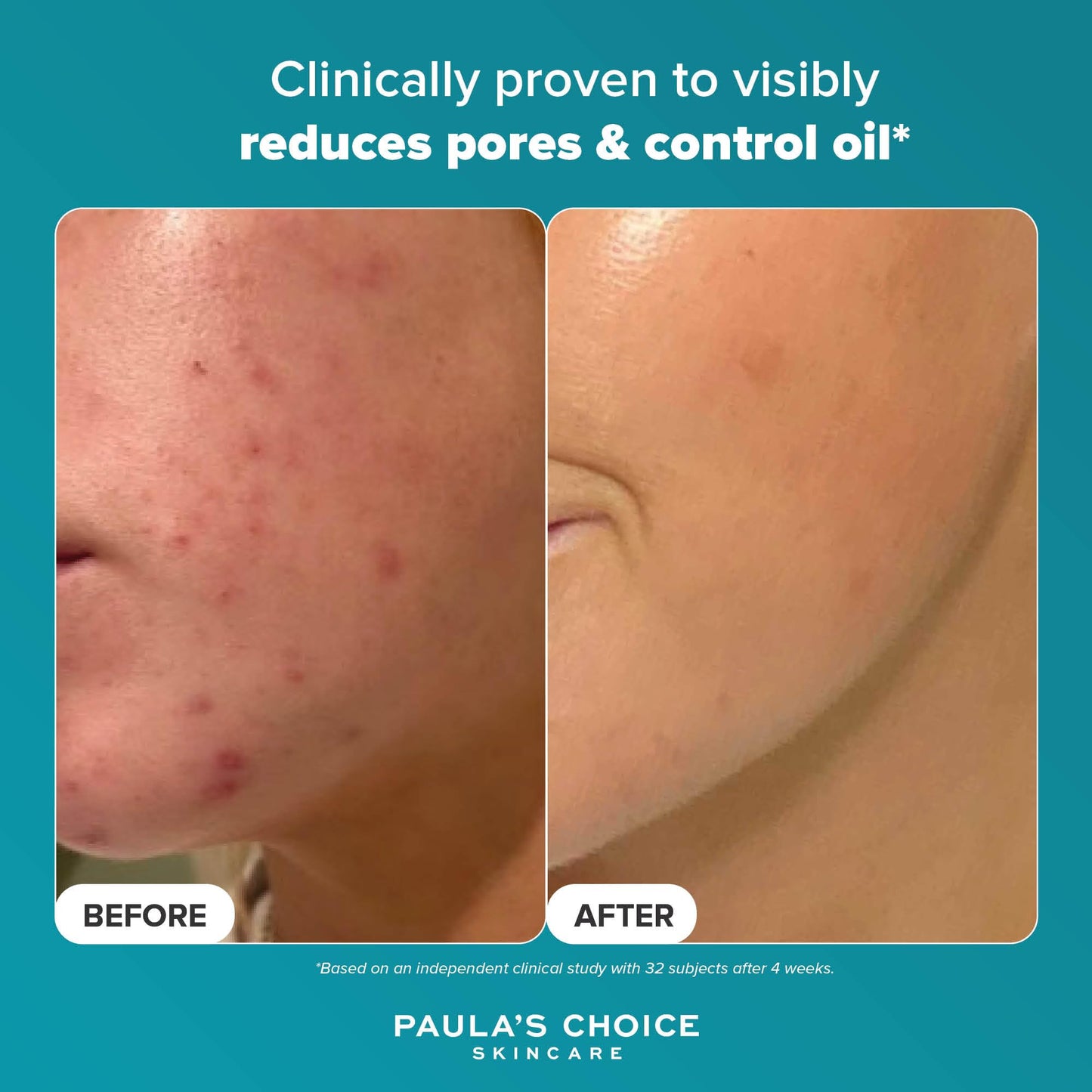 Paula's Choice SKIN PERFECTING 2% BHA Liquid Exfoliant - Face Exfoliating Peel Fights Blackheads & Enlarged Pores - for a Healthy Glow - with Salicylic Acid - Combination & Oily Skin - 30 ml
