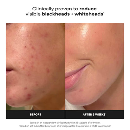 Paula's Choice SKIN PERFECTING 2% BHA Liquid Exfoliant - Face Exfoliating Peel Fights Blackheads & Enlarged Pores - for a Healthy Glow - with Salicylic Acid - Combination & Oily Skin - 30 ml