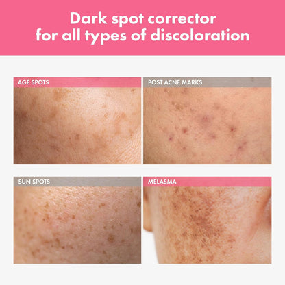 TOSOWOONG Arbutin 7% Intensive Spot Cream with 70,000ppm Arbutin, 3% Tranexamic Acid, 1% Niacinamide, Glutathione, Gentle Skincare for an Even-Looking Skin Tone, Korean Skin Care, 20ml, 0.67 fl.oz.
