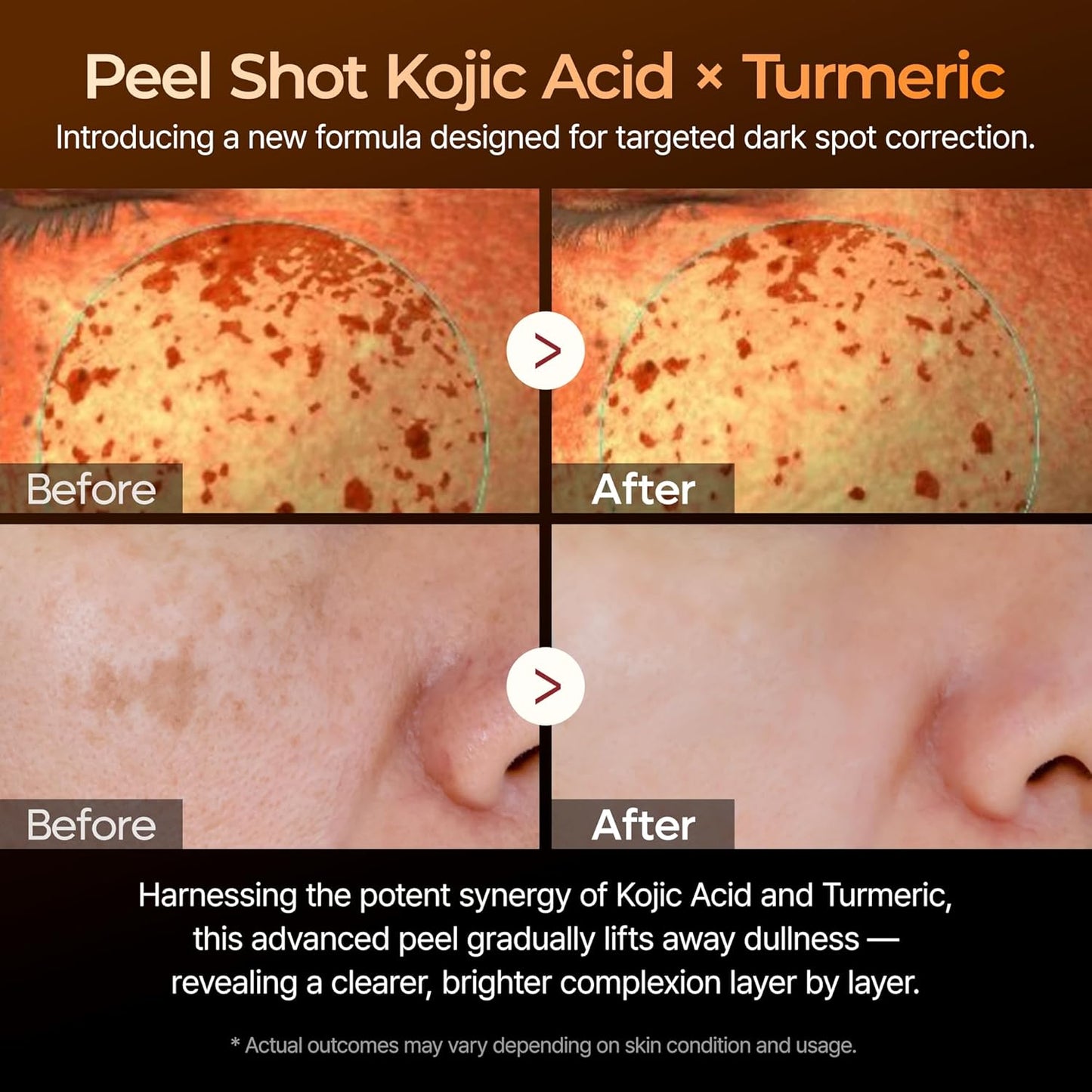 Dr.Melaxin Peel Shot Kojic Acid Turmeric Serum Exfoliating Dark Spot Corrector With Aha/Bha & Niacinamide, Brightening & Even Tone Facial Serum 2.71 Fl Oz (Pack of 1)