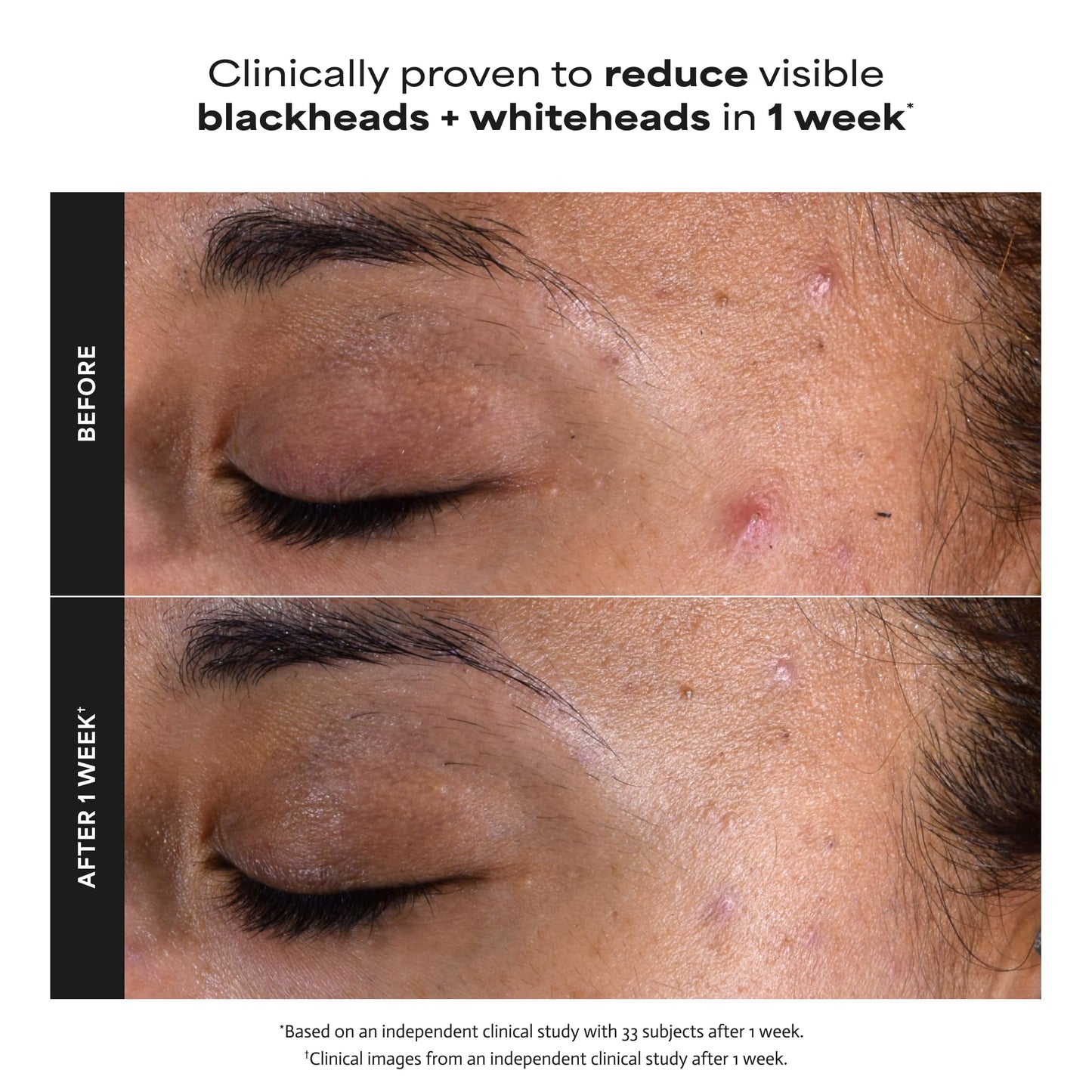 Paula's Choice SKIN PERFECTING 2% BHA Liquid Exfoliant - Face Exfoliating Peel Fights Blackheads & Enlarged Pores - for a Healthy Glow - with Salicylic Acid - Combination & Oily Skin - 30 ml