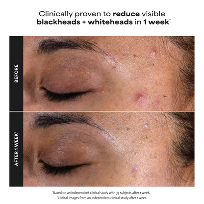 Paula's Choice SKIN PERFECTING 2% BHA Liquid Exfoliant - Face Exfoliating Peel Fights Blackheads & Enlarged Pores - for a Healthy Glow - with Salicylic Acid - Combination & Oily Skin - 30 ml